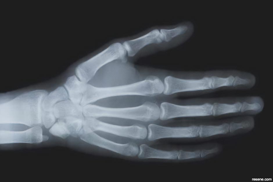X-ray: ultra-violet light